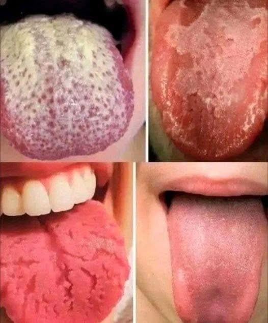 Si vous présentez ces quatre symptômes sur la langue, ils pourraient indiquer des problèmes de santé sous-jacents