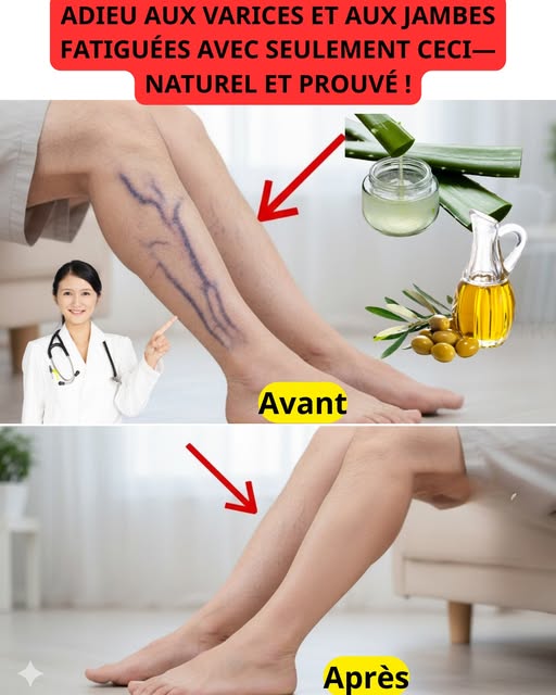 Remède de Grand-mère contre les Varices : Recette Naturelle à base d’Aloe Vera, de Vinaigre et de Citron