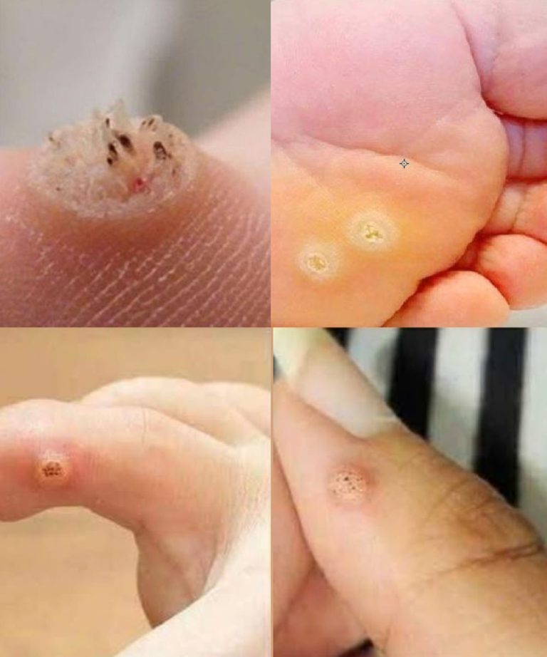 Reconnaître les grains de beauté suspects et agir à temps