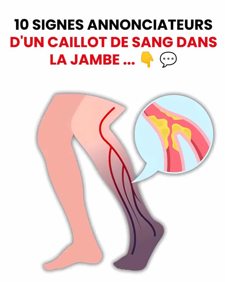 Thrombose : ces signes discrets qu’il ne faut jamais ignorer